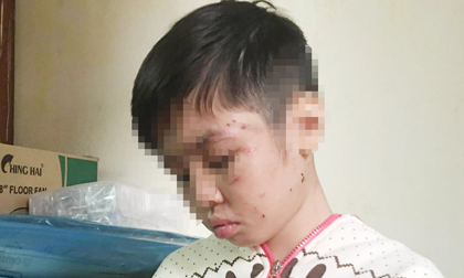 Bé trai bị đánh rạn xương sườn: Mẹ kế khai lý do hành hạ con chồng