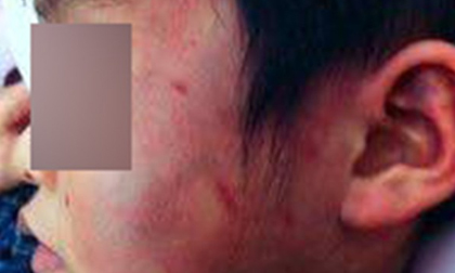 Vụ bé trai 4 bị đánh bầm tím người tại trường học: Kỷ luật hiệu trưởng và giáo viên phụ trách lớp