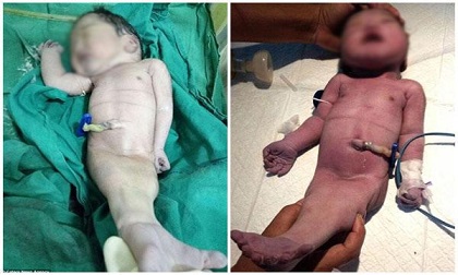 Không có tiền siêu âm, cặp vợ chồng nghèo 'chết lặng' khi sinh ra 'người cá'