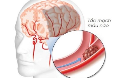 6 dấu hiệu cảnh báo mạch máu bị tắc, cần xử lý nhanh để tránh tử vong