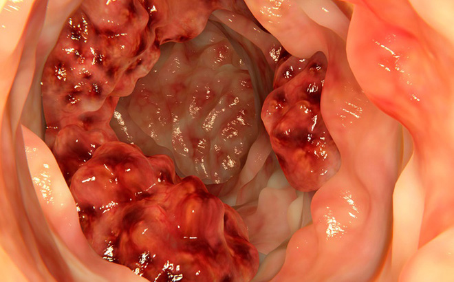 colon-cancer-fi-1-1478786351592-0-55-419-729-crop-1478786361895
