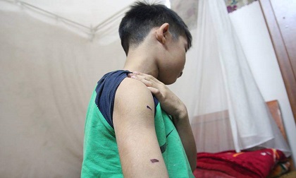 Hà Nội: Bé trai 9 tuổi bị điểm kém, bố dùng dây điện bạo hành dã man