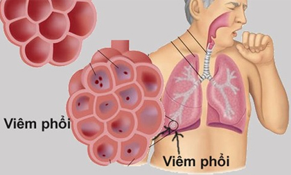 Căn bệnh gây tử vong hàng đầu ở trẻ, cha mẹ cần nhớ các dấu hiệu điển hình này