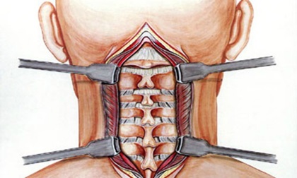 Bẻ cổ, lắc cổ kêu răng rắc gây nguy hiểm như thế nào cho bạn?