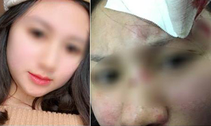 Hà Nội: Người vợ xinh đẹp “tố” bị chồng đánh rách đầu ngay cả khi mang bầu