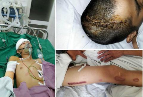 Vu chem chau be vi trom vat: Van ban khoan boi thuong