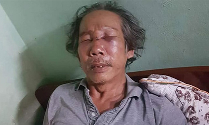 Bảo vệ chung cư Sài Gòn đánh ông già 68 tuổi rách mặt, gãy sống mũi vì đậu xe sai quy định