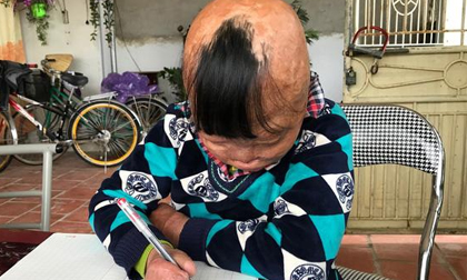 Cuộc sống đầy nghị lực của cậu bé “đuốc sống”