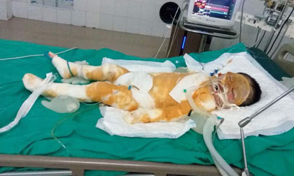 Thái Bình: Chập điện cháy nhà giữa đêm, vợ chồng bỏng nặng, bé gái 4 tuổi nguy kịch