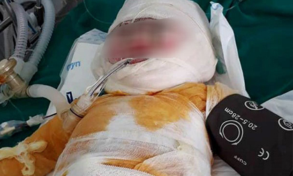 Con ngã vào hố vôi đang sôi, mẹ tuột da, thịt thò tay kéo con lên