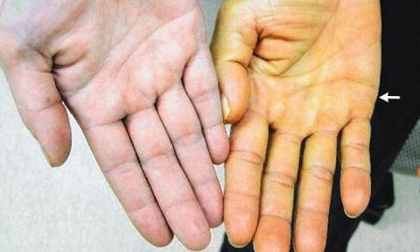 Viêm gan B - căn bệnh cả nhà dễ mắc nhưng ai cũng bỏ qua