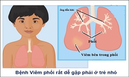 Viêm phổi ở trẻ em: Những điều cha mẹ bắt buộc phải biết