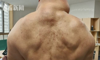 Uống 1 lít rượu/ngày, ông lão hóa ‘quái vật’ vì mắc bệnh hiếm