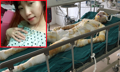 Nghi do mâu thuẫn bạn bè, cô gái xinh đẹp bị tẩm xăng thiêu sống trong lúc ngủ, mức độ bỏng toàn thân 92%