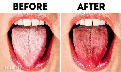 10 cách chữa bệnh lưỡi trắng đơn giản nhất ngay tại nhà