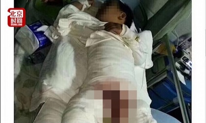 Bé 4 tuổi bị cô giáo mần non dội nước sôi vào người vì... không ngoan