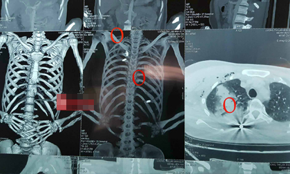 Thông tin mới nhất về sức khỏe nữ Giám đốc bị bắn tại phòng làm việc ở Bắc Giang