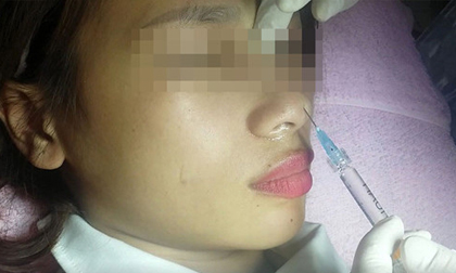 Thẩm mỹ viện tiêm filler làm mù mắt bệnh nhân phải đền bù 350 triệu đồng