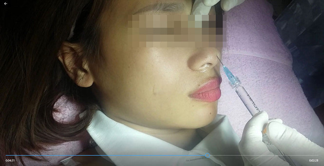 Hình ảnh cô gái bị tiêm filler và di chứng đến mức mù mắt