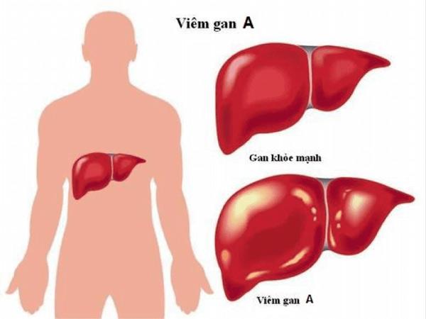 chet vi nhiem viem gan a do an luu dong lanh: canh giac loat benh de lay qua an uong - 2