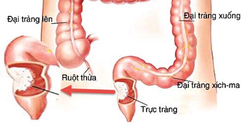 bi ung thu truc trang vi an cay buoi toi: ghi nho 6 “khong” trong bua toi tranh ruoc benh - 2