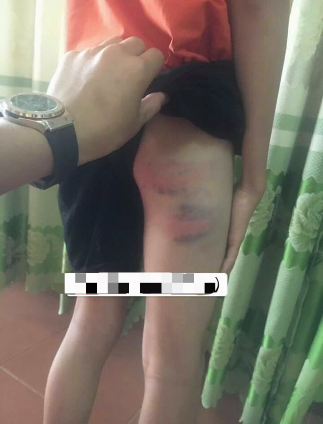 Bé trai 12 tuổi nghi bị mẹ kế đánh nhập viện ở Nghệ An: Mẹ kế là giáo viên, do thằng bé ăn nói hỗn láo nên mới dạy - Ảnh 3.
