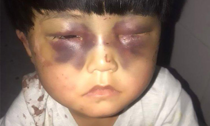 Bé gái 4 tuổi bị bố bạo hành tới mức mắt sưng và thâm tím, ai nhìn cũng xót xa