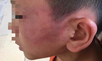 Bé trai 12 tuổi nghi bị mẹ kế bạo hành ở Nghệ An vẫn chưa hết sợ hãi khi nhắc tới chuyện về nhà