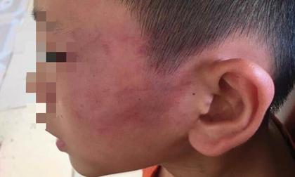 Vụ mẹ kế nghi bạo hành cháu bé 12 tuổi đến nhập viện ở Nghệ An: Công an vào cuộc, đang lấy lời khai hai bên liên quan