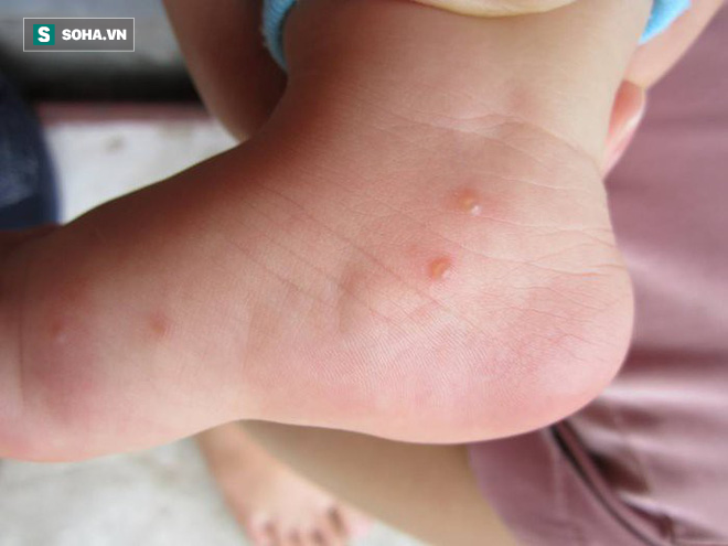 Hà Nội: Nguy cơ bùng phát dịch tay chân miệng rất lớn, 6 điều cha mẹ không được bỏ qua
