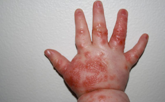 Hà Nội: Nguy cơ bùng phát dịch tay chân miệng rất lớn, 6 điều cha mẹ không được bỏ qua