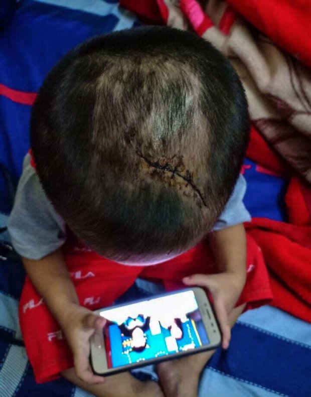 Bé T có vết thương lớn trên đầu, phải đi khâu lại.