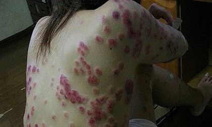 Căn bệnh xã hội “bị lãng quên” nhưng cực kỳ nguy hiểm