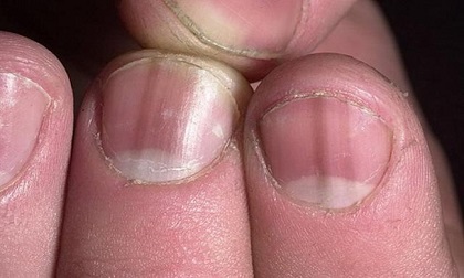 Nhìn dấu hiệu ở móng tay, biết ngay bạn đang mắc bệnh gì