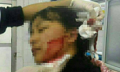 Sau khi rạch mặt và ngực tình trẻ của chồng vẫn phải thừa nhận 'nhìn rất được'