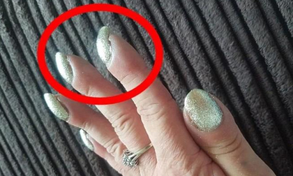 Thấy móng tay quặp vào trong, đi khám mới ngỡ ngàng biết mắc bệnh nguy kịch
