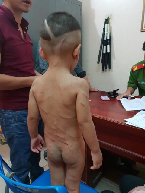 Loi khai ke danh con rieng cua vo chi chit vet thuong