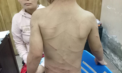 Đã có kết luận thương tích bé trai bị cha dượng đánh dã man ở Phú Quốc