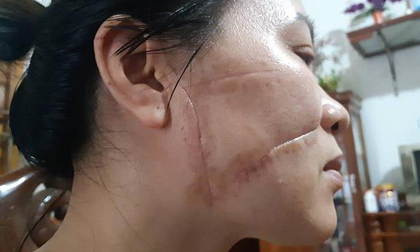 Người chồng rạch mặt, cắt gân chân của vợ trần tình: “Chỉ vì quá yêu vợ nên mới làm vậy”