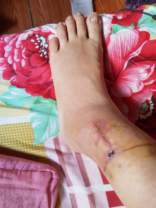 khoi to ga chong mau lanh dung dao rach mat, cat gan chan vo hinh anh 2