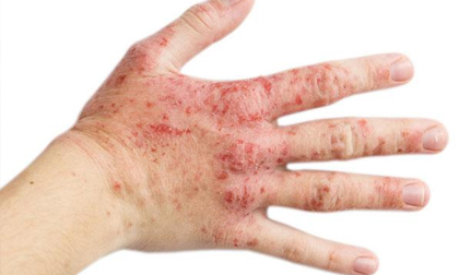 Vết bầm tím trên da cảnh báo loạt bệnh nguy hiểm, đọc ngay để phòng kịp thời