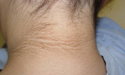 Bé 10 tuổi có vệt đen trên cổ, bác sĩ nói tuy nhẹ nhưng cảnh báo bệnh nguy hiểm hơn