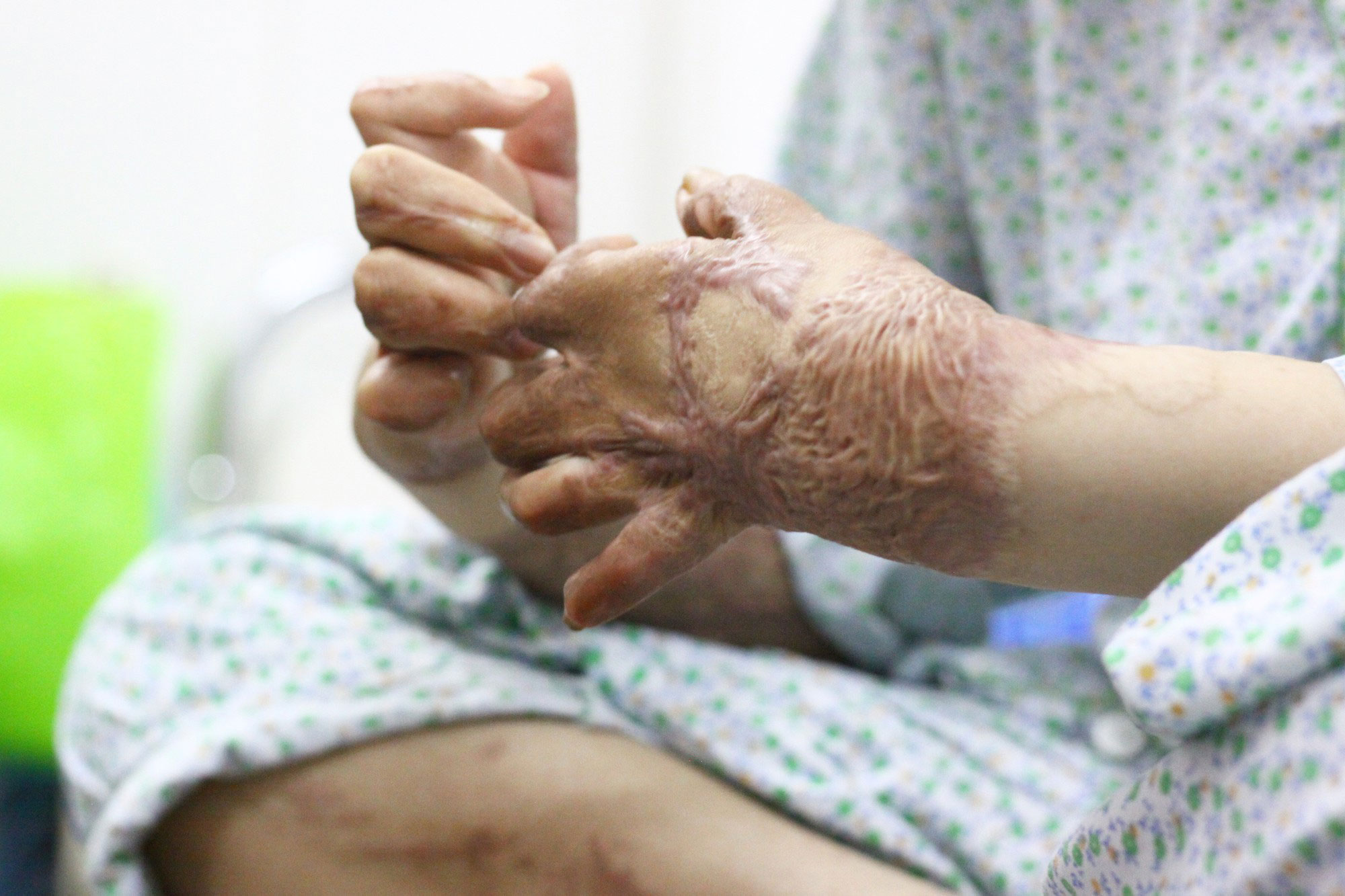 Sau 1 năm và hàng chục cuộc phẫu thuật, người vợ Hà Nội bị chồng thiêu hôm mùng 2 Tết, chỉ có 1% cơ hội sống sót đã hồi sinh