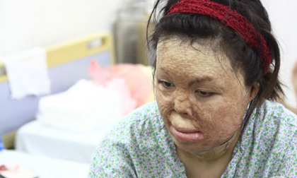Sau 1 năm và hàng chục cuộc phẫu thuật, người vợ Hà Nội bị chồng thiêu hôm mùng 2 Tết, chỉ có 1% cơ hội sống sót đã 'hồi sinh'