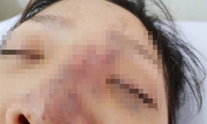 Một nữ sinh có nguy cơ mù mắt vì tiêm filler