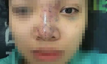 Nữ sinh bị mù mắt khi tiêm filler: Dấu hiệu đáng ngờ bên trong spa