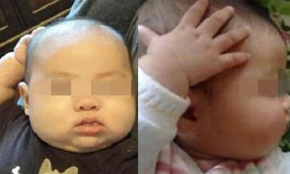 Thấy con hay sờ đầu, gãi tai, mẹ ngỡ ngàng khi biết con mắc bệnh lúc nào không hay
