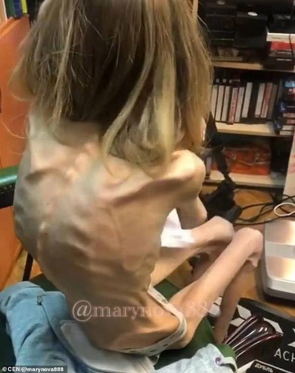 hoang hon co gai 26 tuoi nang von ven 17kg, gay nhu 