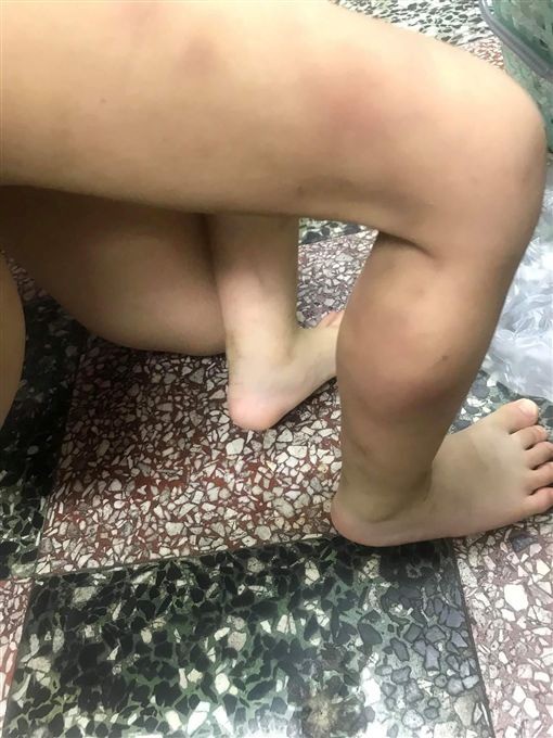 Vết bầm chi chít trên người đứa bé tội nghiệp.