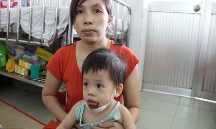 Mẹ nghi con 18 tháng bị nữ bảo mẫu đổ nước sôi bỏng miệng
